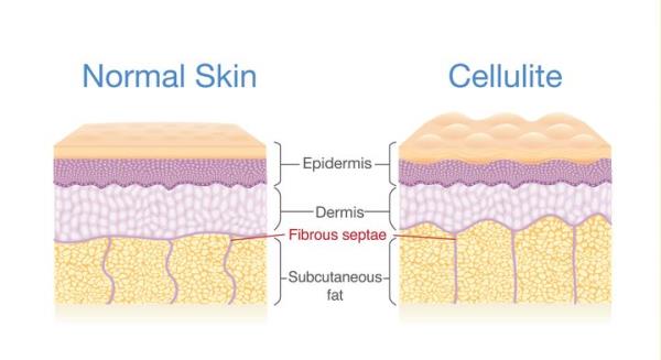 Cellulite forms when the co<em></em>nnective tissues (made of collagen) between your muscle and skin squeeze fat cells toward your epidermis, creating a bumpy, dimpled appearance.