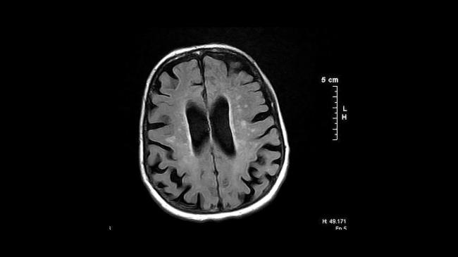 50-facts-a<em></em>bout-binswanger-dementia